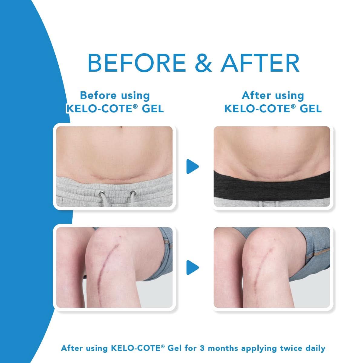 KELO-COTE® - Gel de silicon pentru tratamentul cicatricilor Cosmetice si Infrumusetare Naty Shop